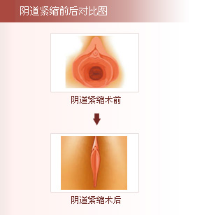 阴道松弛修复术前后对比图