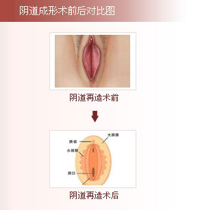 阴道成形术前后对比图