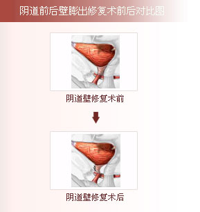 阴道前后壁膨出修复术前后对比图