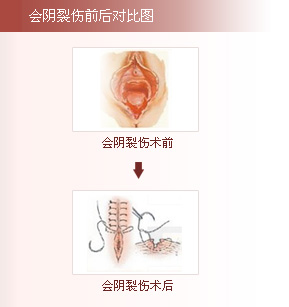 韩式会阴裂伤修复术前后对比图