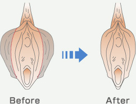 阴唇整形